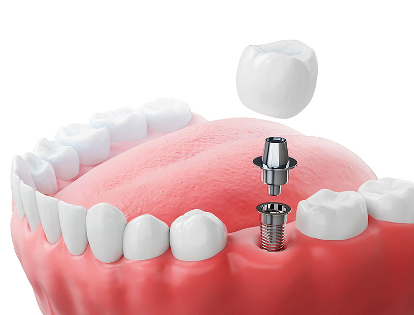 Implants Dentaires